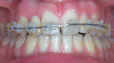 traitement orthodontie paris 20